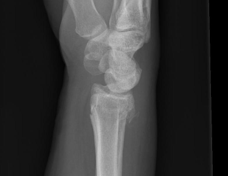 DISI CIND Secondary Radial Fracture